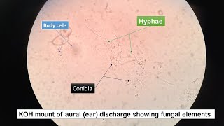 Ear discharge in KOH mount showing fungal elements hyphae and conidia [upl. by Eille]