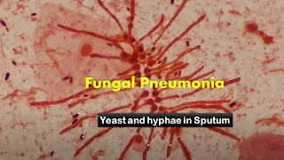 Heavy load of fungus in Sputum Microscopy [upl. by Zenia]