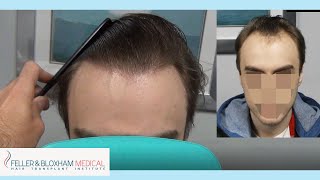 Natural Hairline Hair Transplant  Feller amp Bloxham Medical  New York amp Philadelphia [upl. by Kenweigh380]