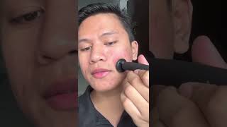 Watch His Acne amp Acne Scarring TRANSFORM acnescars skincare [upl. by Hertzfeld]