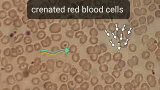 Crenation in blood film smear shows numerous of Burr cells or crenated red blood cells echinocytes [upl. by Brietta]