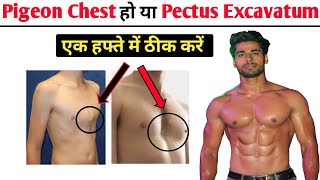 Pigeon chest ko kaise thik kare  Pectus Excavatum Exercises  Funnel Chest exercises  Pigeon Chest [upl. by Meeharb208]