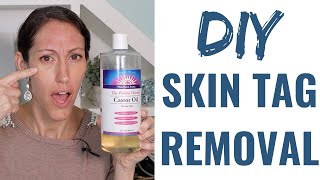 How to Get Rid of a Skin Tag  Natural Skin Tag Removal Home Remedies amp Tips [upl. by Jo-Anne]