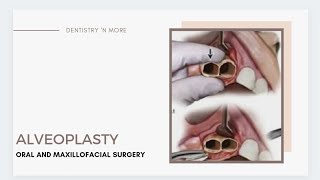 ALVEOLOPLASTY  DEANS ALVEOLOPLASTY  OBWEGESERS ALVEOLOPLASTY  ALVEOLECTOMY [upl. by Nave]