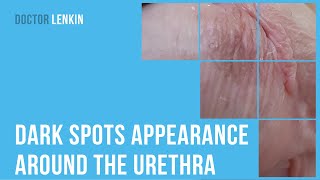 😕 Dark spots appearance around the urethra after treating chlamydial urethritis [upl. by Dermott146]