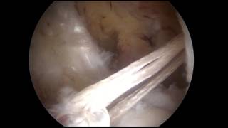 ACL Reconstruction with Single Bundle Hamstring Graft Graftlink [upl. by Lachus31]