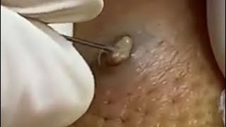 2020 Comedones Popping Dermatology Blackheads Zits and Whiteheads Cysts [upl. by Kred]