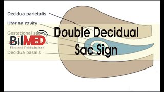 DOUBLE DECIDUAL SAC SIGN  Vlogs  BilMed USG Training [upl. by New]