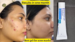 Adaferin gel 01 reviews  adaferin gel 01 how to use  adaferin gel for acne scars  adapalene [upl. by Ariana]