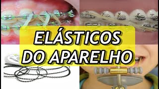 Tipos de ELÁSTICOS do Aparelho Ortodôntico  FUNÇÕES DE CADA UM DELES [upl. by Capwell]