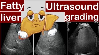 Fatty liver Ultrasound grading [upl. by So]