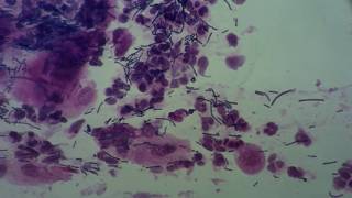 Gynaecology Vagina Lactobacillus acidophilus and leucocytosis Pap smear [upl. by Adiuqal]