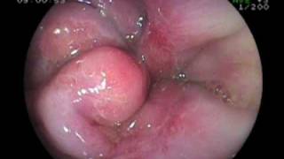 Esophageal Erosion Esophageal Varice Stomach Ulcer and Duodenitis [upl. by Arin]