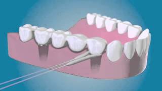 TePe Bridge amp Implant Floss  Diş İpi [upl. by Kenzie317]