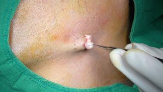 Epidermal Cyst on neck of middle aged man Removal Surgery HD 중년 남성의 목에 생긴 표피 낭종 제거술 [upl. by Haley848]