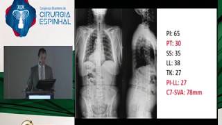 Doença do segmento adjacente descompressão x extensão da fusão x cirurgia da deformidade [upl. by Dde594]