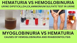 HOW TO DIFFERNTIATE HEMATURIA VS HEMOGLOBINURIA VS MYOGLOBINURIACAUSES URINE DIPSTICKLDH AND CK [upl. by Edecrem870]