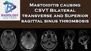 Mastoiditis causing CSVT Bilateral transverse and Superior sagittal sinus thrombosis [upl. by Alihs723]