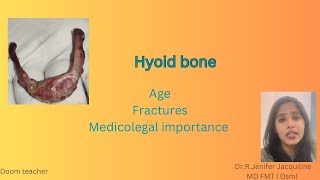 Hyoid bone Age Types of fractures Medicolegal importance  Forensic Medicine [upl. by Ardnaiek455]