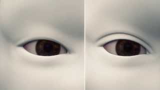 How double eyelid surgery works [upl. by Thayne235]