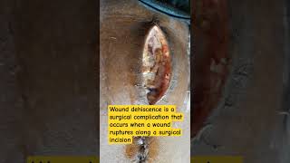 Wound Dehiscence in midline incision post emergency Laparotomy Surgery [upl. by Cohla]