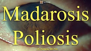 Madarosis y Poliosis [upl. by Aicnelev]