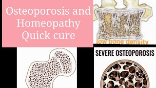 Homeopathic medicine for Osteoporosis  Dr ali Homeo care [upl. by Aneerhs]