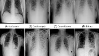 Chest Xray Pathology  Radiology  Education 123radiology 123radiology Radiologando [upl. by Kciwdahc]