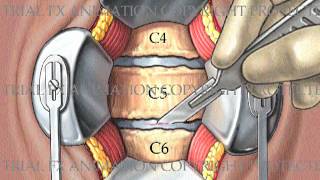 2 Level Cervical Arthrodesis with ProDiscC [upl. by Nylrahs]