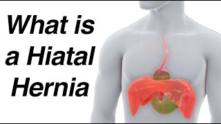 What is a Hiatal Hernia Animation amp How It Causes Reflux [upl. by Yllehs]