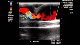 Dialysis Access Evaluation  Case Study [upl. by Ainafets33]