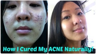 How I Cured My ACNE Naturally 10 Tips [upl. by Erminia]