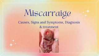 MISCARRIAGE Causes Signs and Symptoms Diagnosis and Treatment [upl. by Eedolem167]