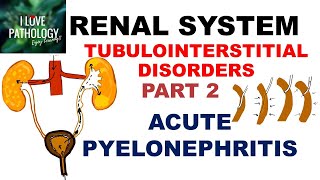 ACUTE PYELONEPHRITIS Pathology [upl. by Rebba566]