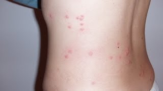 How to Treat Flea Bites on Humans and Pets [upl. by Enniotna510]