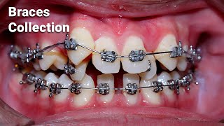 braces process collection [upl. by Naraa970]