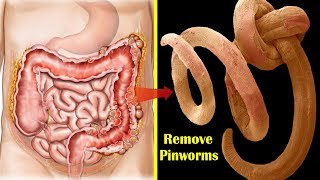 How to Get Rid of Pinworms Overnight  Top 9 Home Remedies for Pinworms During Pregnancy [upl. by Egwin160]