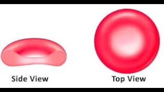 Pathogenesis of Sideroblastic Anemia Part two Cashirki 10aad [upl. by Ganley]