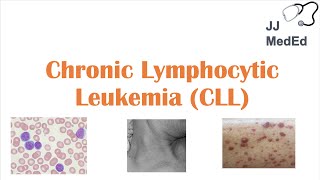 Chronic Lymphocytic Leukemia CLL Symptoms ex Skin Blisters Diagnosis and Treatment Vit D [upl. by Eirehc880]