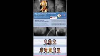 SICOTIAA Total Hip Replacement in Dysplastic Hips Abhay elhenceRakesh rajput [upl. by Scully]