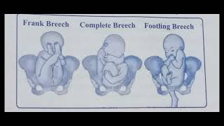 Breech presentation  obg  bsc nursing gnm  obg [upl. by Blatt]