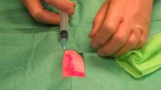 Suturing 1 Infiltrating local anaesthetic [upl. by Lybis181]