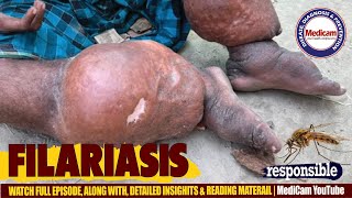 🦟Filariasis Lymphatic Filariasis Causes Symptoms and Treatment Options [upl. by Chill]