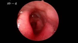 Laryngopharyngeal Reflux Complicated with Granulomas of Bilateral Arytenoids [upl. by Raul85]