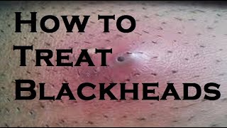 how to treat blackheads Best [upl. by Eyak87]