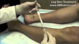 Sclerotherapy  Varicose Vein Treatment  Dr Goldman [upl. by Ignatius]