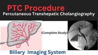 Percutaneous Transhepatic Cholangiography PTC Xray procedure PTC Xray ProcedureIn UrduHindi [upl. by Nepil170]