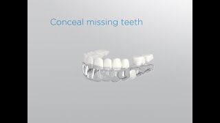 SureSmile Aligners Pontics [upl. by Ttenaej]