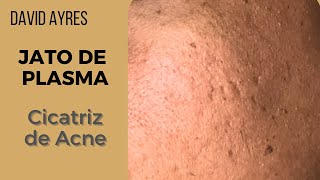 Tratamento para cicatriz de acne com Jato de Plasma [upl. by Adlig]