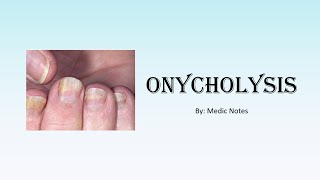 Onycholysis Plummers nail causes and pathophysiology [upl. by Naitirb327]